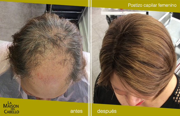 Cálculo Rebaño Escupir Prótesis capilares para mujeres con alopecia - La Maison del Cabello